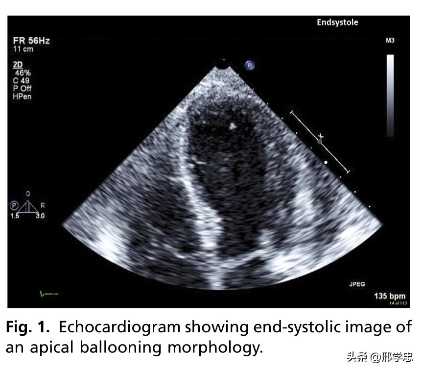 应激性心肌病搭桥,应激性心肌病反复