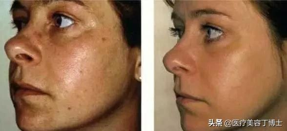 毛孔粗大皮肤又干是什么肤质,毛孔粗大的克星怎么解决