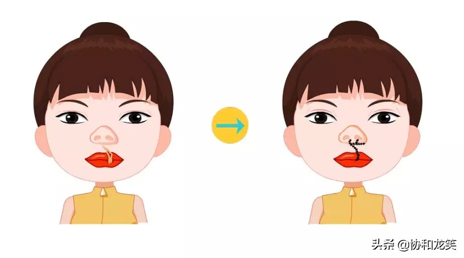 什么是唇部,唇部提拉术