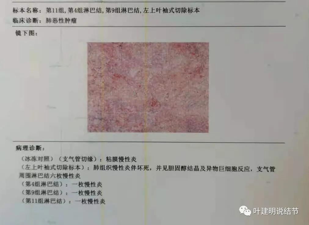 中央型肺癌手术前辅助治疗,中央型肺癌治疗后活过10年的病例