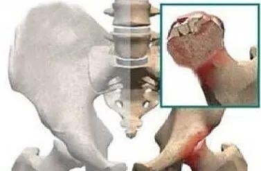 股骨头疼痛夜间明显是怎么回事,股骨头疼痛五个月能到什么程度