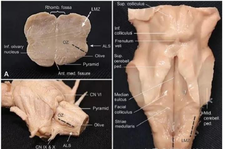 脑干海绵状血管瘤开颅手术,脑干做手术的示意图