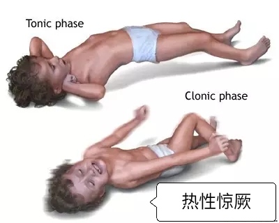 小孩37度2抽搐算不算热性惊厥,小孩发热惊厥抽搐的表现