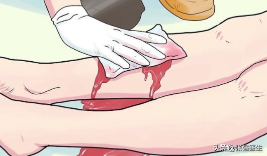 高龄老人静脉曲张破裂怎么办？