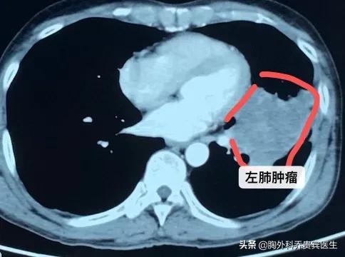 为什么肺癌出现右肩痛,为什么肺癌会浑身疼