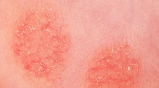 春季婴儿湿疹高发日常护理很关键,哺乳期孩子湿疹家长需要排湿气吗