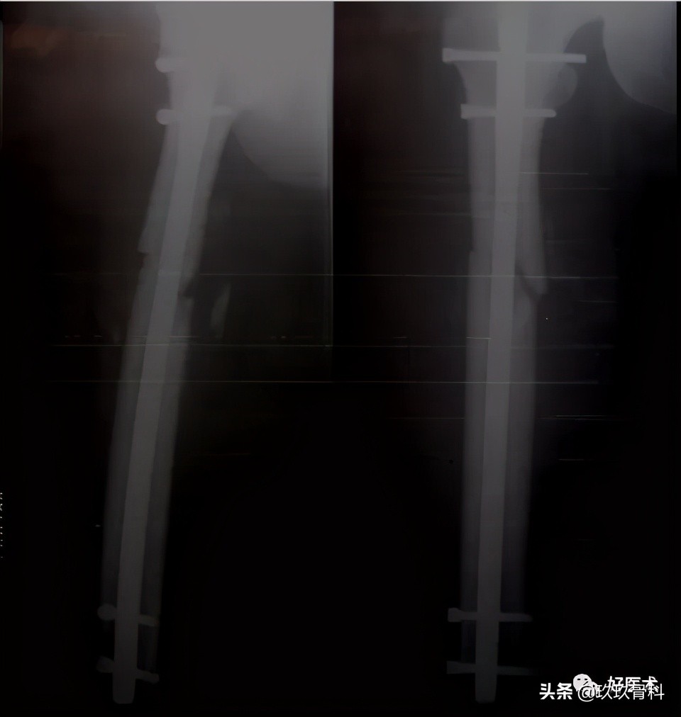 髓内钉技巧,髓内钉教学视频讲解