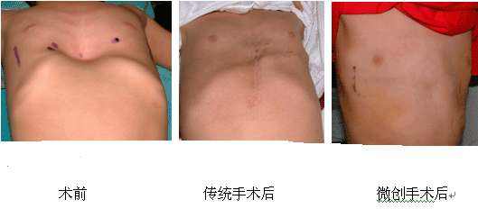 漏斗胸已经有了怎么预防,漏斗胸怎么预防