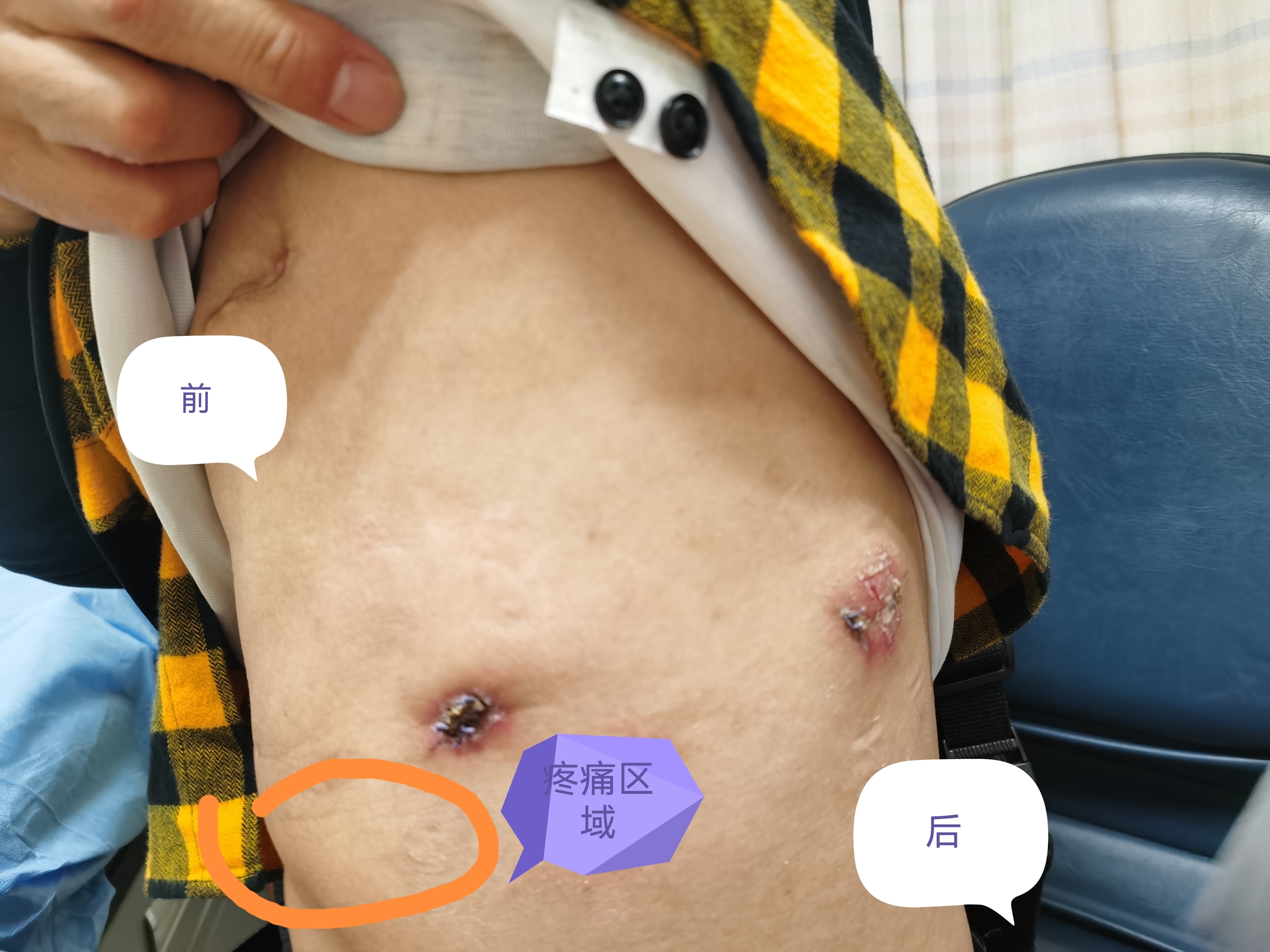 胸外科手术后全身酸痛怎么办,胸外科手术术后疼痛的原因