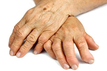 类风湿治疗半年怎么一点不见效,类风湿治疗快一年了效果不好