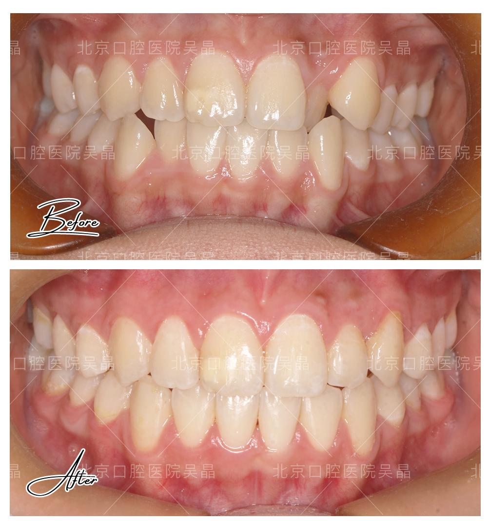 牙齿矫正牙套丢了怎么办,牙齿矫正过程中怎么防止牙套松