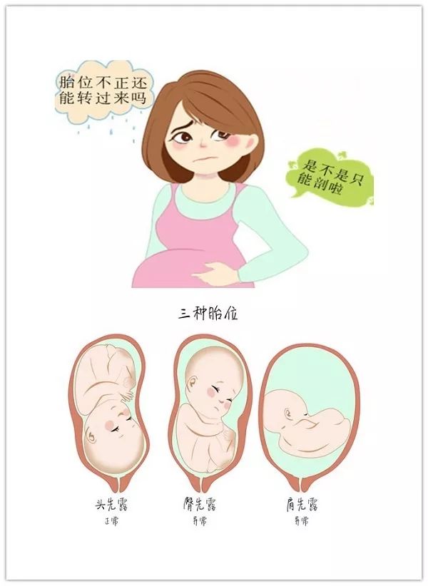 臀位想顺产怎么办,头臀位双胞胎顺产