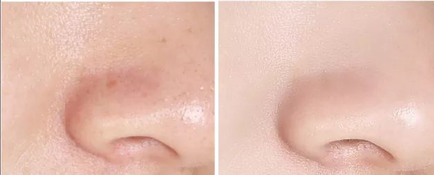 用了成百上千张化妆棉，皮肤却越来越薄了，原来是打开方式不正确