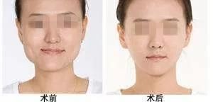 牙齿小洞不补下一句是什么,牙齿小洞不补大洞吃苦的意思