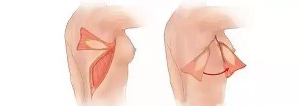 乳房肿块和纤维腺瘤,乳腺纤维腺瘤肿块有无血流信号