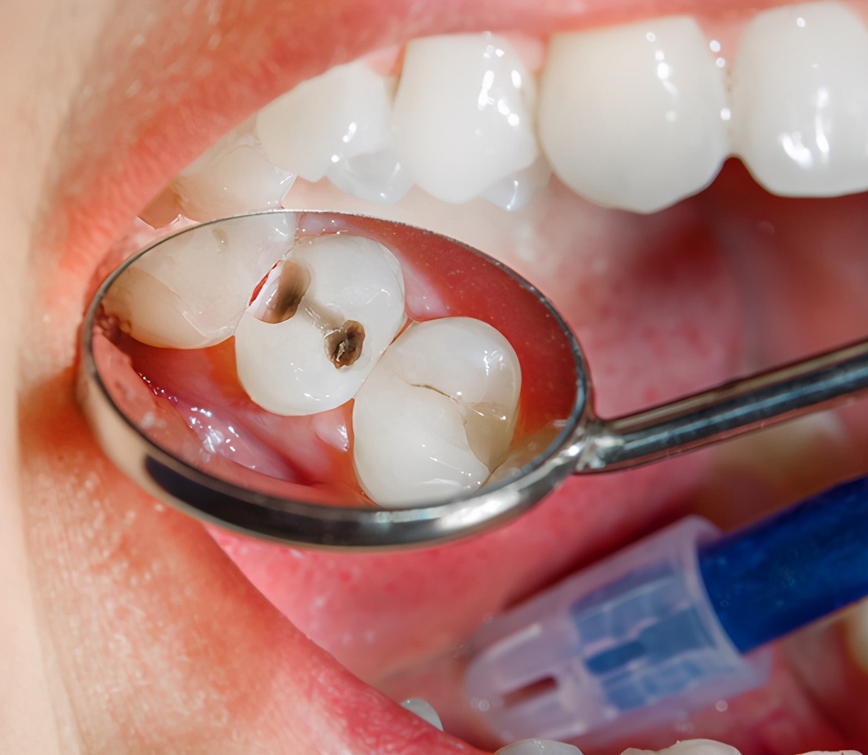 为什么补了牙齿反而牙齿痛,牙齿不痛牙龈疼痛为什么