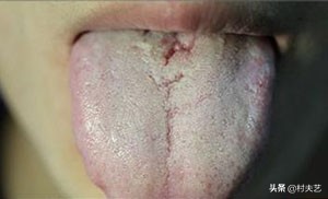 舌苔与疾病对照表详细,舌苔黑是什么疾病产生