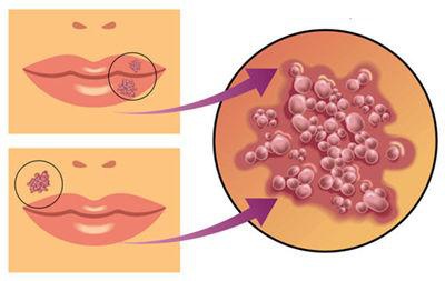 嘴边上火起泡结痂变红要多久能好,嘴角起泡是病毒感染还是细菌感染