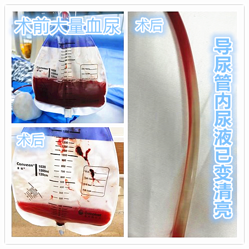 膀胱癌出现大量血尿怎么办吧?