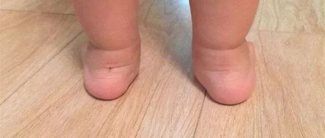 足外翻的四个原因,足力健足部知识小课堂