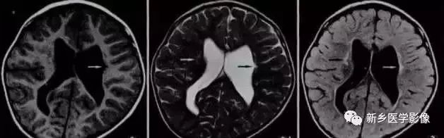 影像学脑室扩大,脑室显大怎么理解