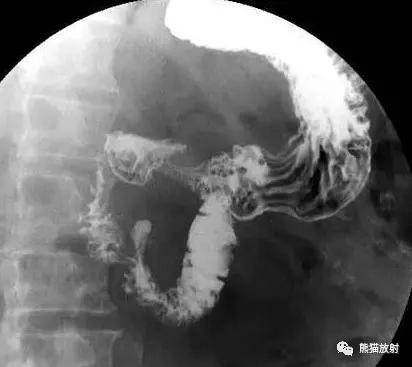 十二指肠球部溃疡解剖位置,十二指肠球部溃疡x线表现
