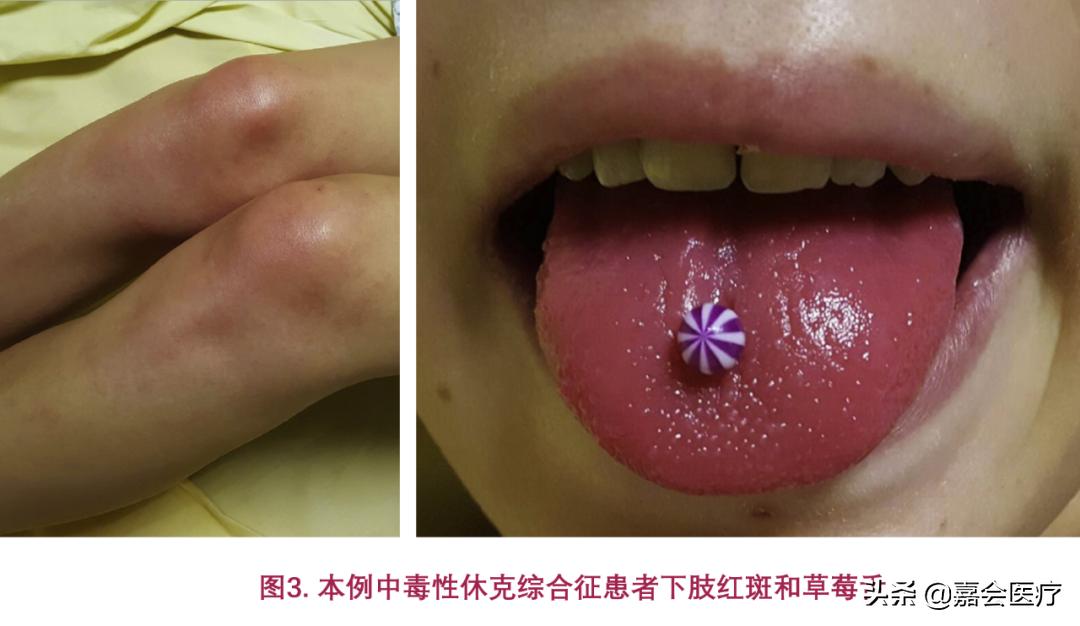 孩子只有草莓舌和发热是川崎病吗,川崎病草莓舌的症状