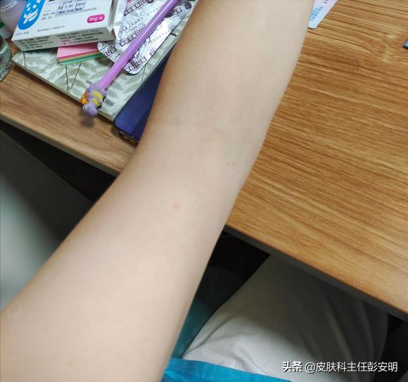 银屑病抗争经历,我与鱼鳞病的抗争