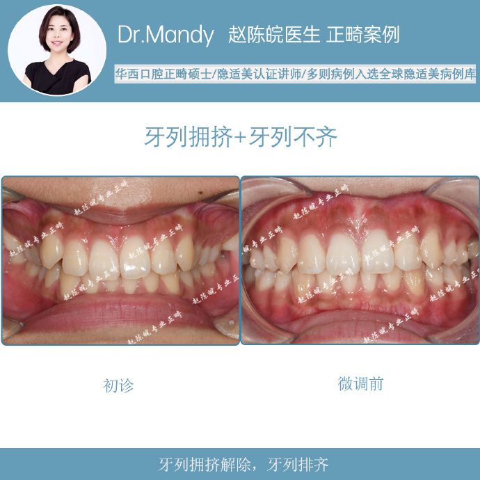 隐适美隐形矫正成功案例,经典隐形矫正