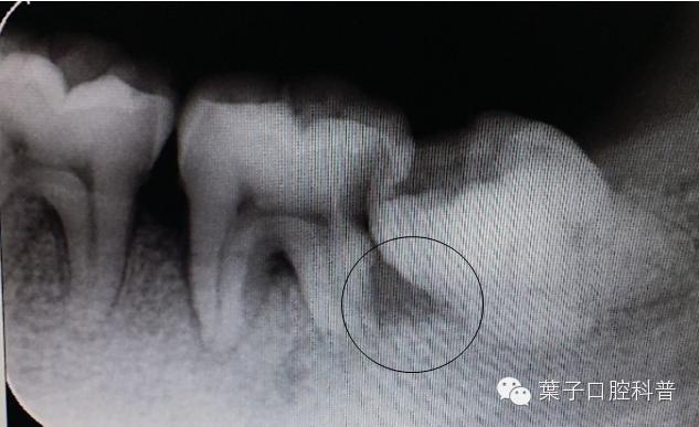 拔智齿十大危害,拔智齿利与弊