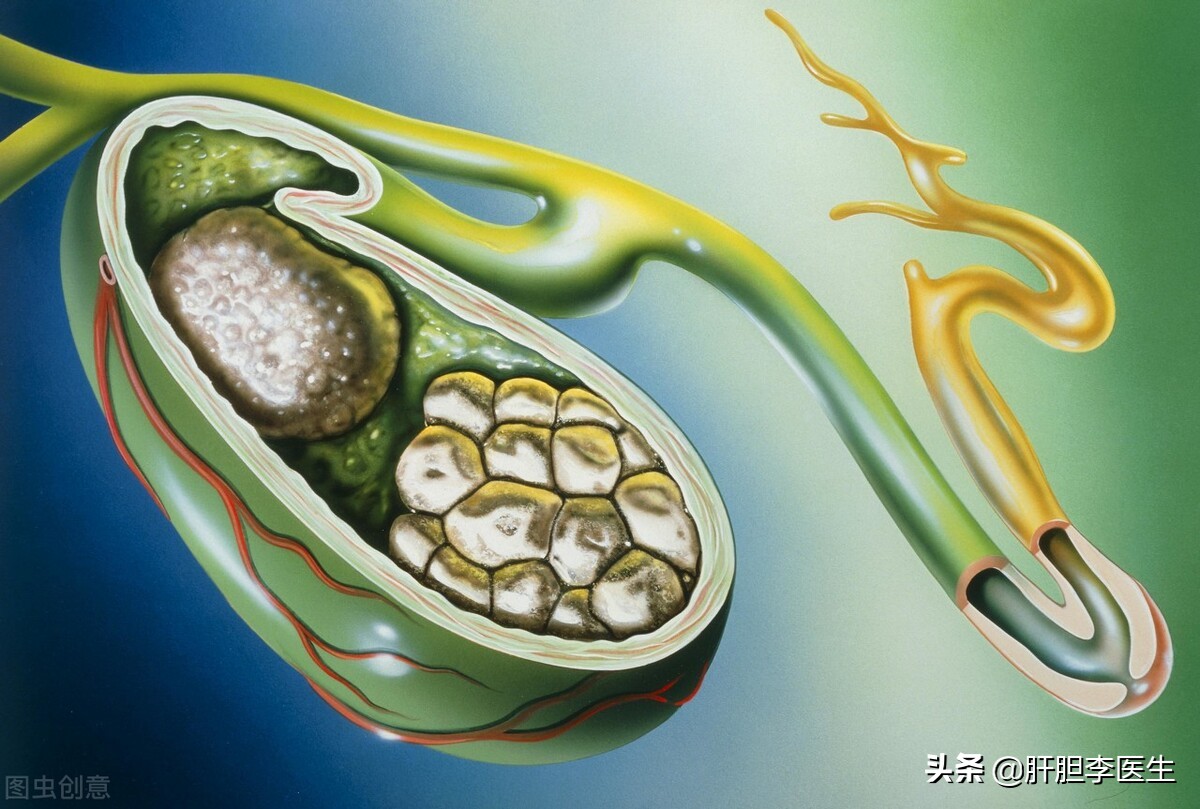 胆囊结石大的好还是小的好,胆囊结石和肾结石哪个比较严重