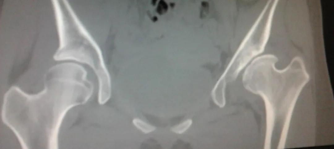 儿科先天性髋关节脱位的分型为,先天性髋关节脱位分级