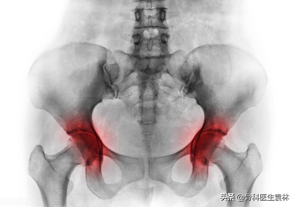 股骨头坏死手术后多久能恢复,股骨头坏死保髋手术恢复姿势视频