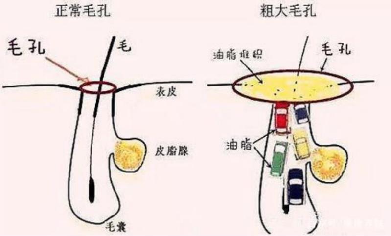 改善皮肤毛孔粗大的方法有哪些,皮肤粗糙暗沉毛孔粗大怎么改善
