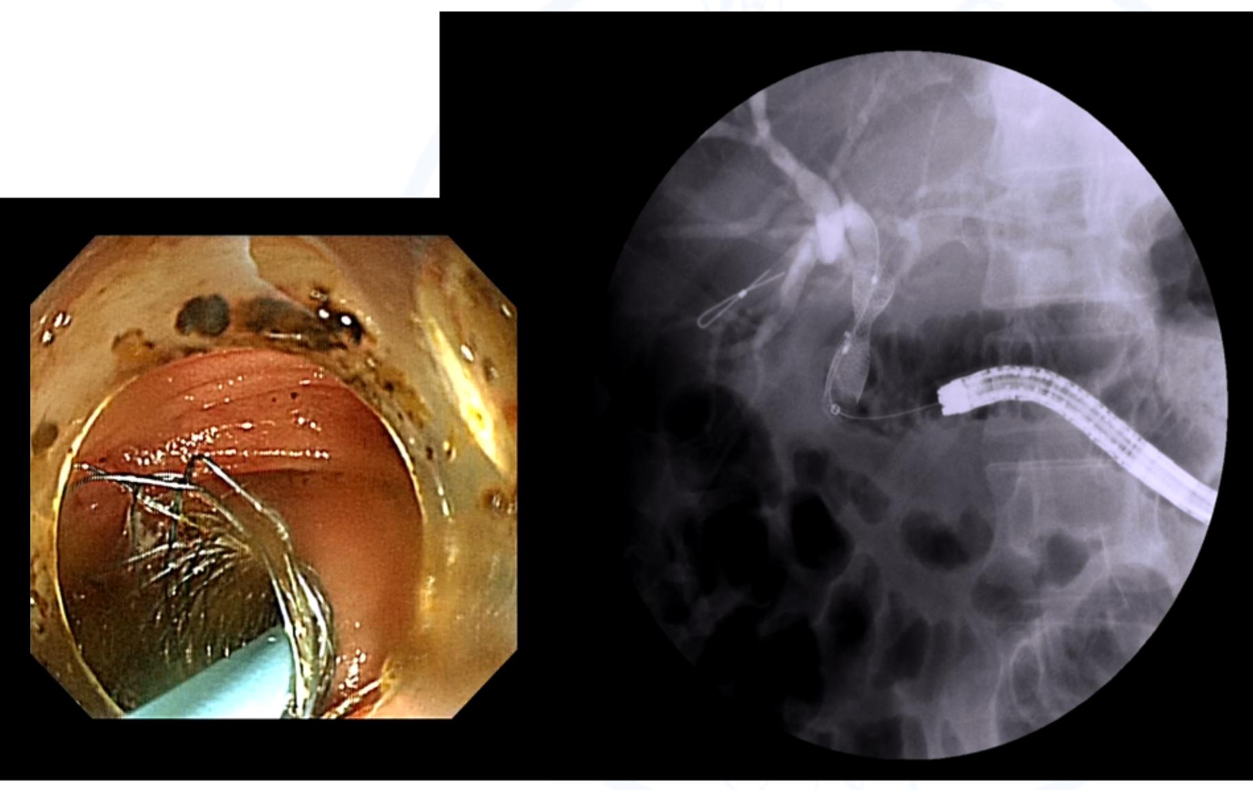 胆肠吻合术后胆瘘怎么处理,胆肠吻合口狭窄术后还会复发吗