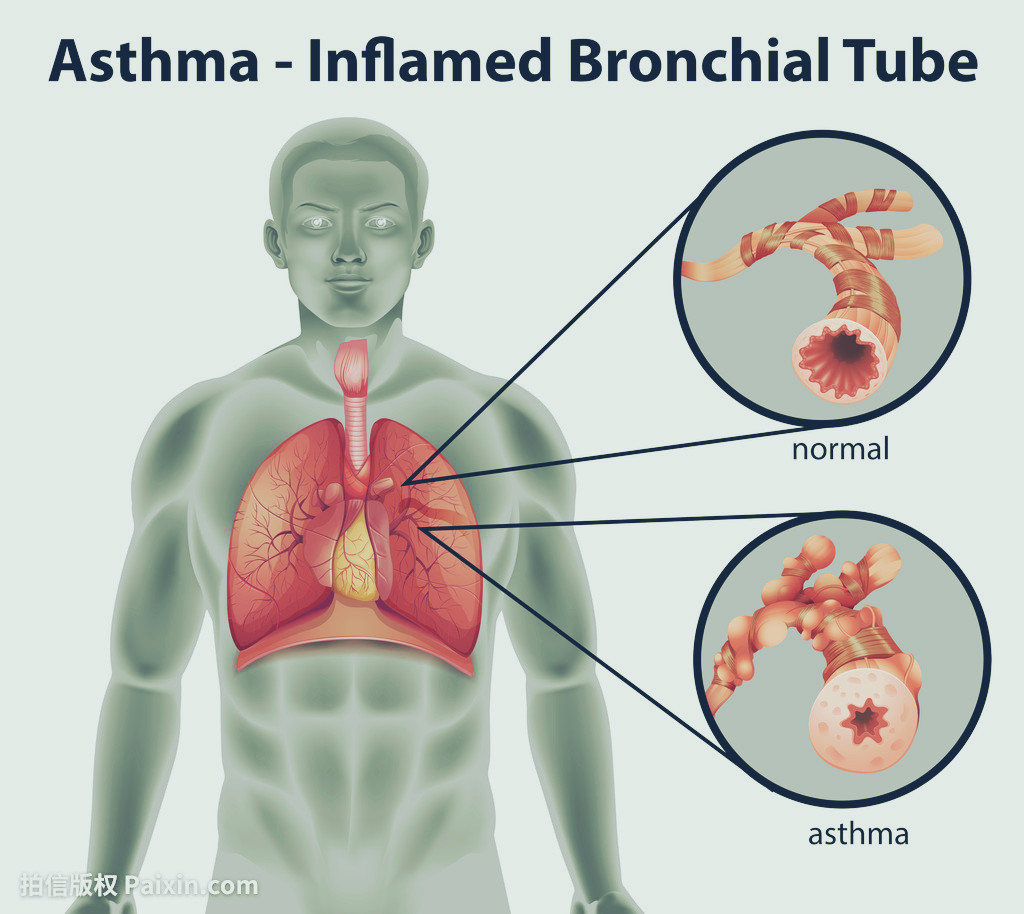 咳嗽变异性哮喘用哪些药好,治疗哮喘有喘除根这种药吗