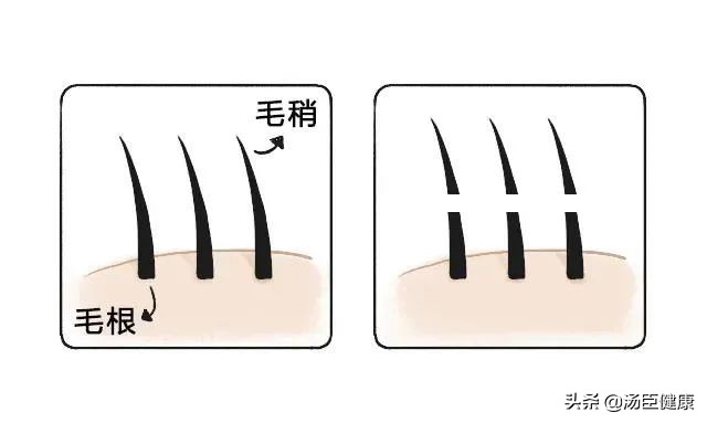 其它地方的毛发可以移植到头上吗,身上的毛可以移植到头发上吗