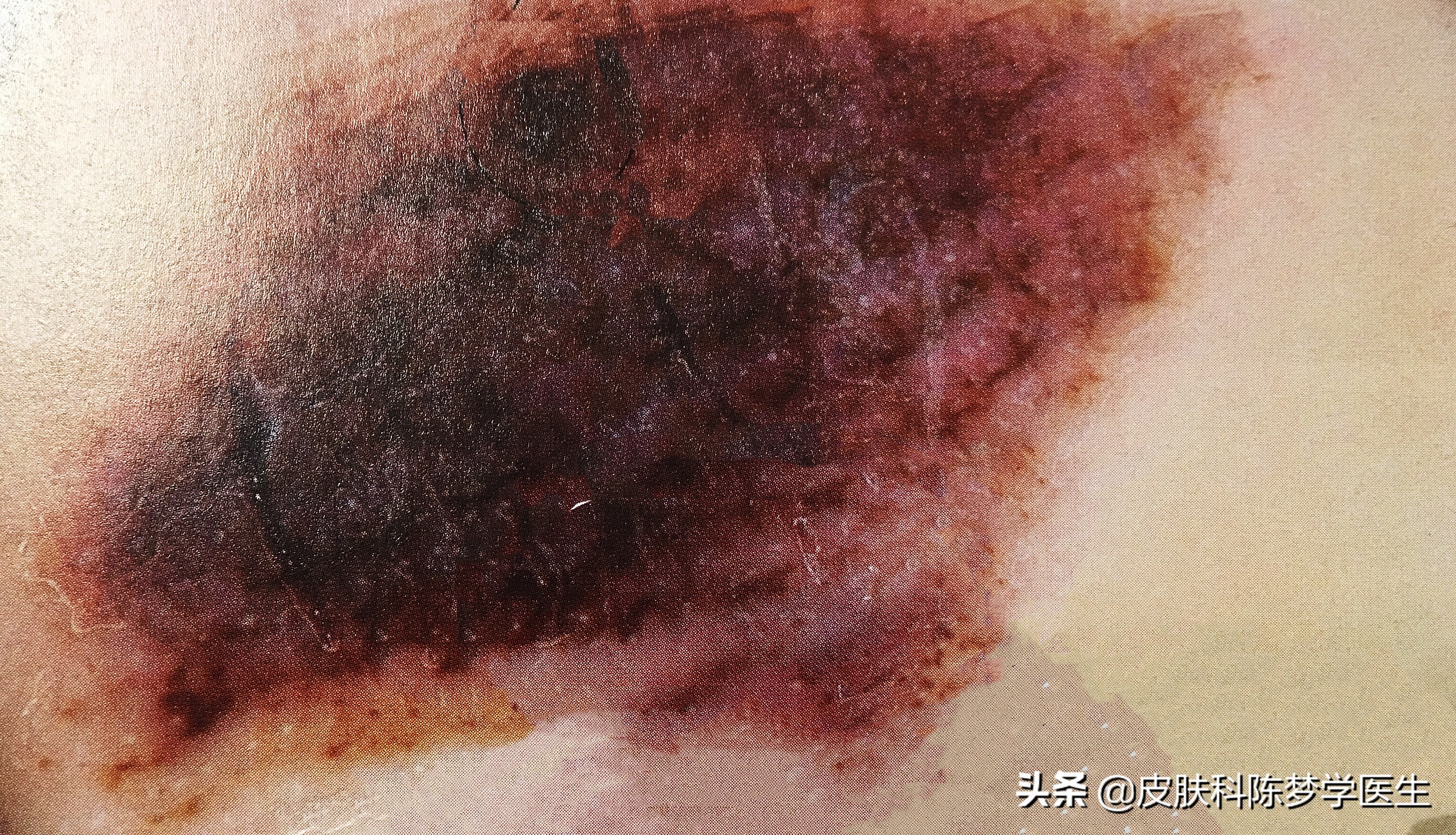 激光点痣适合多大的痣,激光点痣以后痣晕开了怎么办