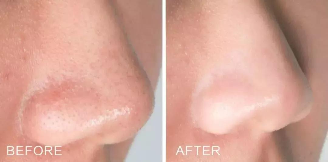 缓解抬头纹的最佳方法,抬头纹太严重了如何缓解去除