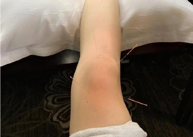 膝盖积水需要注意什么,怎么才能防止膝盖积水