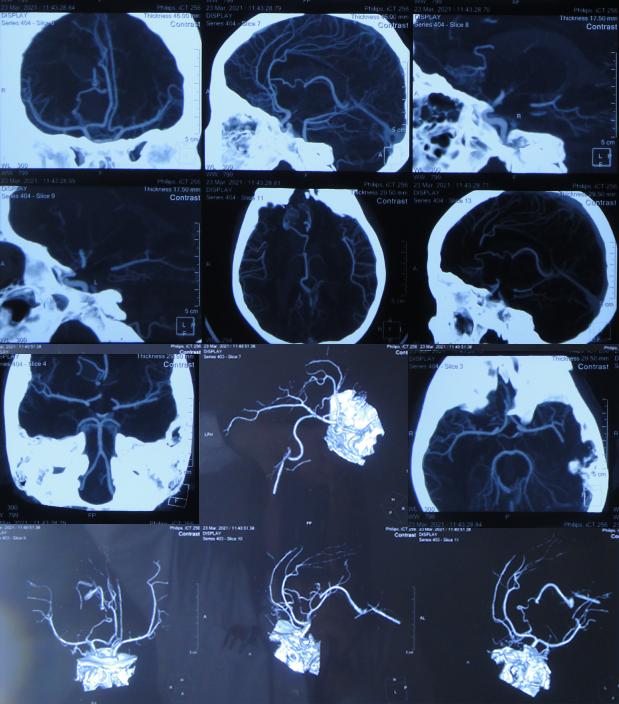 儿童脑出血昏迷三天后恢复正常了,脑出血后脑积水多久会出现症状