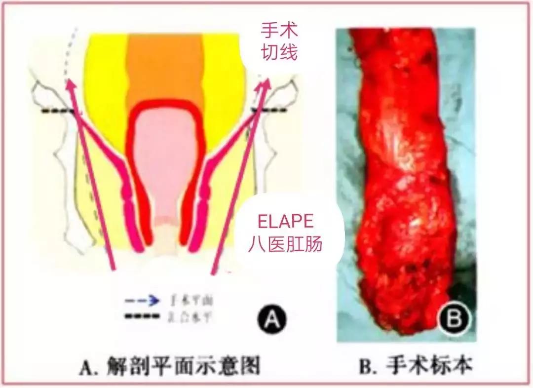 「技术」青岛市第八人民医院肛肠外科高难手术挽救低位直肠癌患者