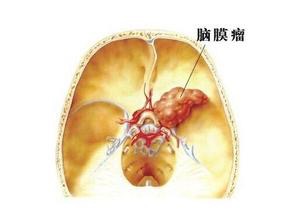 三甲医院治疗肿瘤曝光,脑部肿瘤的最佳治疗方法