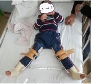 脑瘫踝关节术后康复,脑瘫完全康复