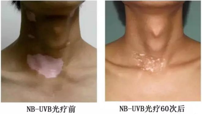 紫外线治疗白癜风会发黑发红吗,白癜风患者怎样预防紫外线