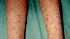 过敏性紫癜常见类型及鉴别,过敏性紫癜最常见的类型是什么