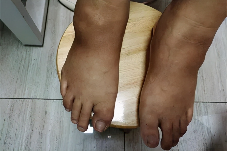 别让痛风伤害你的肾，治疗痛风不拖延，融晶，保肾，调代谢