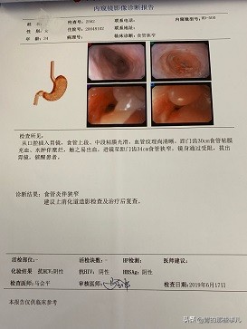 食管反流引起的胸痛吃什么药,多年胃食管反流