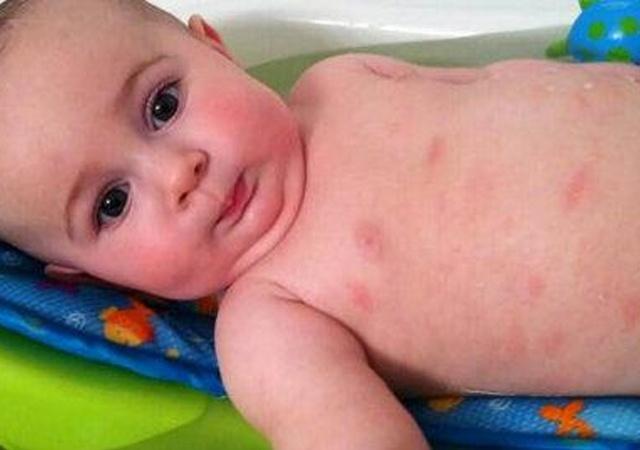 宝宝湿疹结痂的最佳治疗方法,婴儿湿疹结痂又破了怎么办