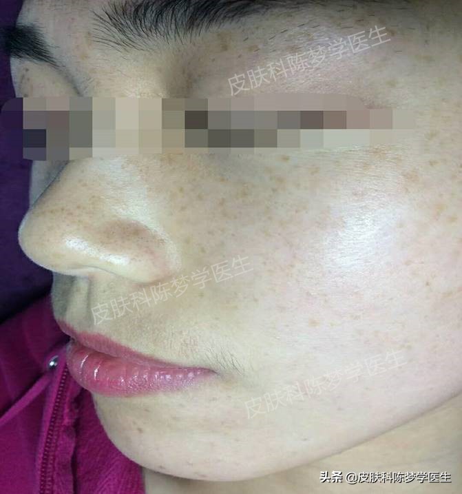 褐青斑是雀斑样痣吗,脸上太田痣怎么祛斑